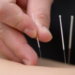 Treatment by acupuncture. The doctor uses needles for treatment of the patient.